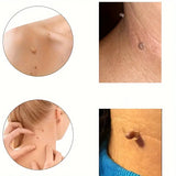 10-piece Skin Tag Removal Kit